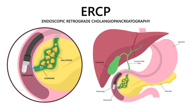 ERCP Yöntemi ile Safra Yolu Hastalıkları Tedavisi