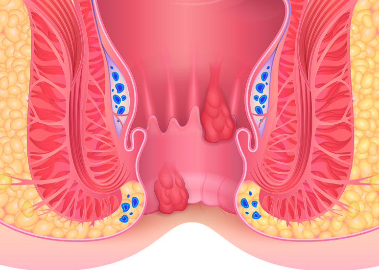 Radyofrekans ile Hemoroid (Basur) Tedavisi Nedir? 