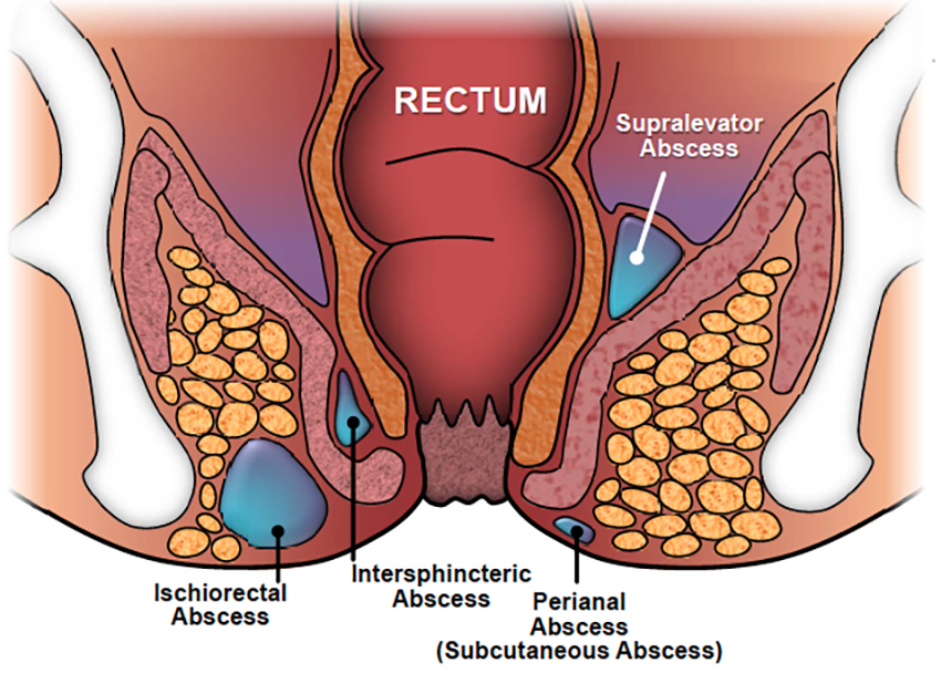  Perianal Apse (Makat Apsesi) Nedir?