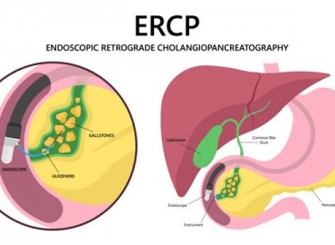 ERCP Yöntemi ile Safra Yolu Hastalıkları Tedavisi