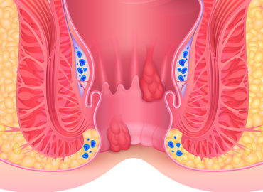 Radyofrekans ile Hemoroid (Basur) Tedavisi Nedir? 