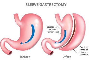 Tüp Mide Ameliyatı Sonrası Beslenme Nasıl Olmalı?