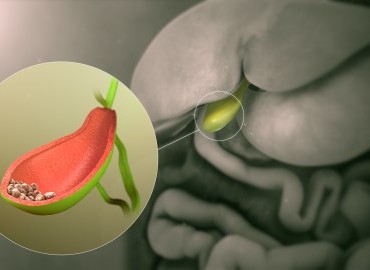 Safra Kesesinde Taş Olanlar Ne Yememeli?