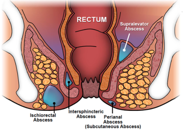  Perianal Apse (Makat Apsesi) Nedir?