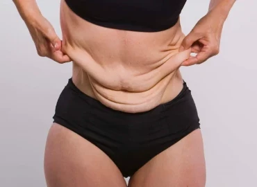 Obezite Cerrahisi Sonrası Cilt Sarkması ve Çözüm Yolları