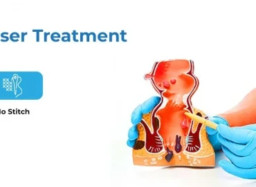 Anal Fissür Tedavisinde Lazer Yönteminin Avantajları