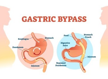 Gastrik Bypass Ameliyatı Sonrası Hayat: Neler Beklemelisiniz?