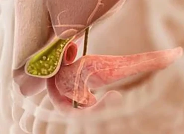 Kapalı Safra Kesesi Ameliyatı: Geleneksel Yöntemlere Göre Avantajları