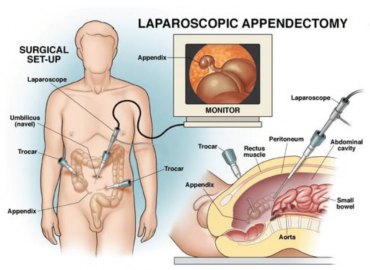 Obezite Ameliyatı Sonrasında Dren Takılması ve Dren Çekilmesi Ağrı Oluşturur mu?