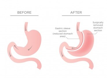 Tüp Mide Ameliyatı Sonrası Hıçkırık Neden Olur?