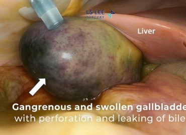 Safra Kesesi İltihabı (Kolesistit) Belirtileri ve Acil Müdahale