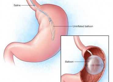 Mide Balonu Uygulaması: Kimlere Uygun?