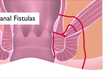 Perianal Fistül Nedir?