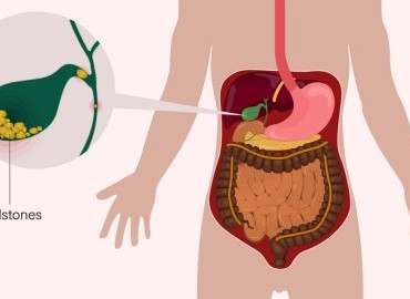 Safra Kesesi Taşlarının Nedenleri ve Önleme Yöntemleri