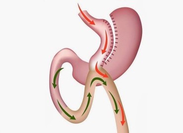  Tüp Mide ve Gastrik By-Pass Arasındaki Fark Nedir?