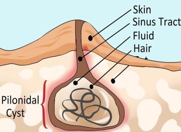 Kıl Dönmesi (Pilonidal Sinüs) Nedir? 