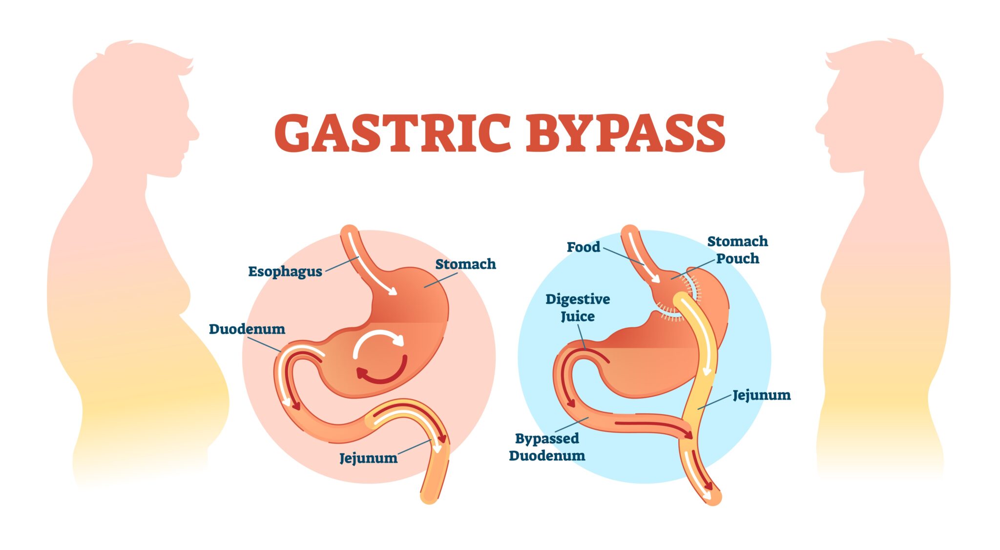 Gastrik Bypass Ameliyatı Sonrası Hayat: Neler Beklemelisiniz?