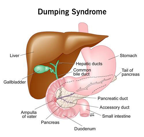 Gastrik Bypass Sonrası Dumping Sendromu: Belirtiler ve Çözüm Yolları