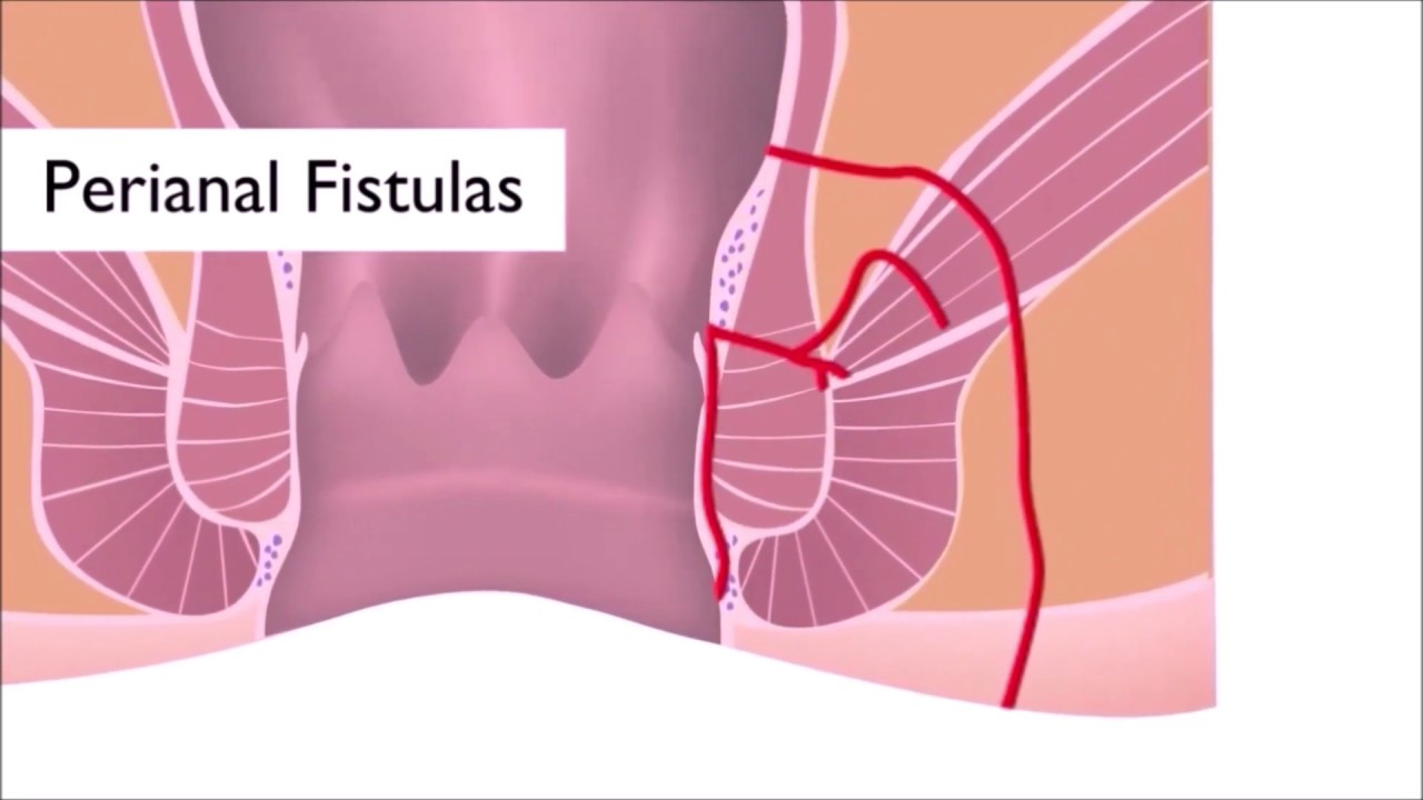 Perianal Fistül Nedir?
