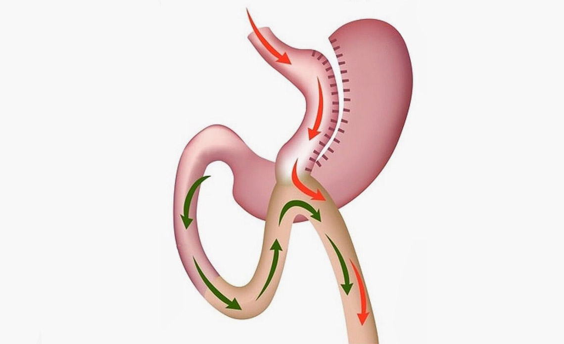 Tüp Mide ve Gastrik By-Pass Arasındaki Fark Nedir?