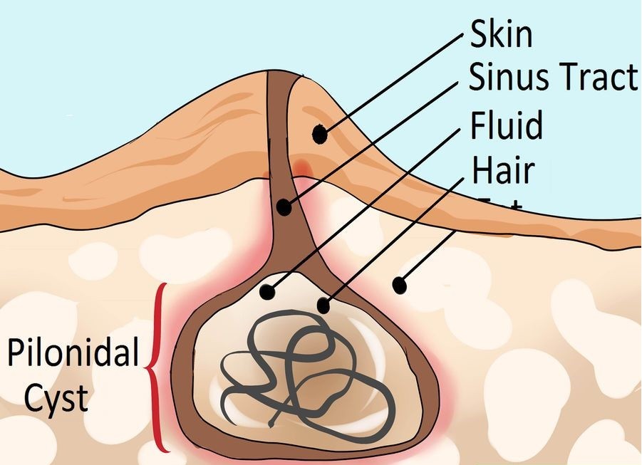 Kıl Dönmesi (Pilonidal Sinüs) Nedir? 